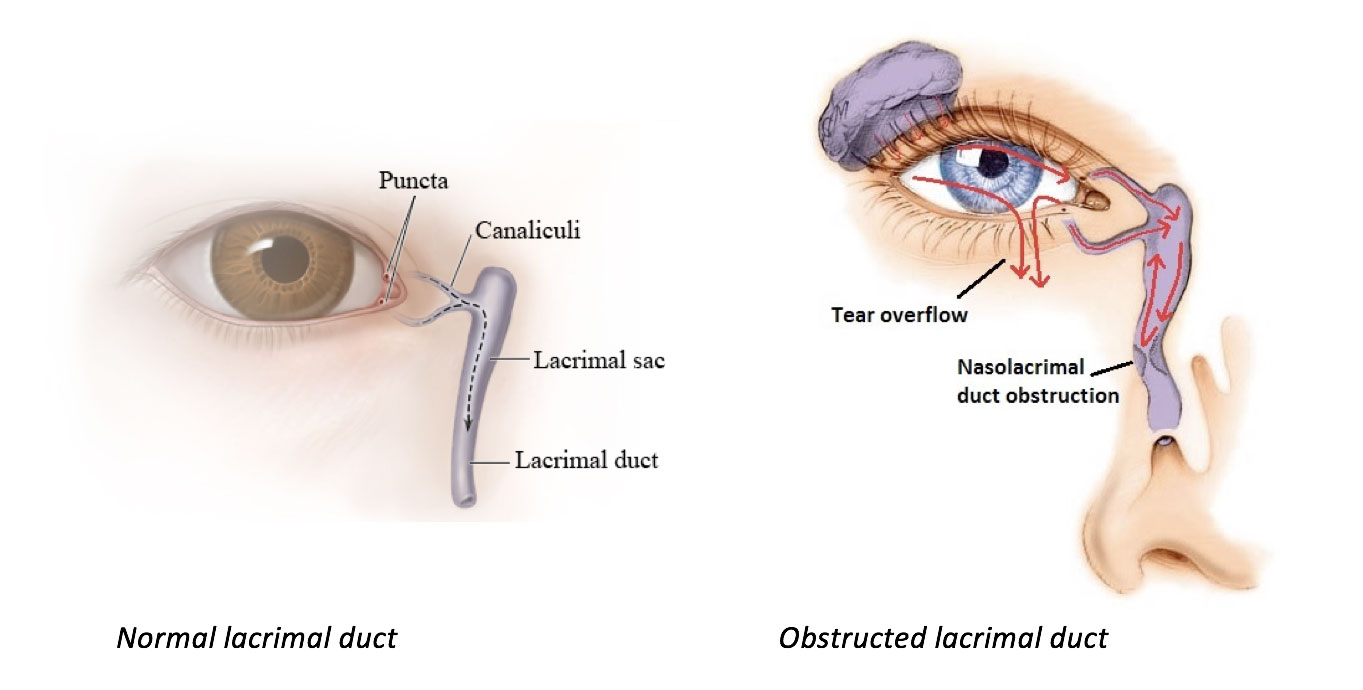 Congenital NasoLacrimal Duct Obstruction