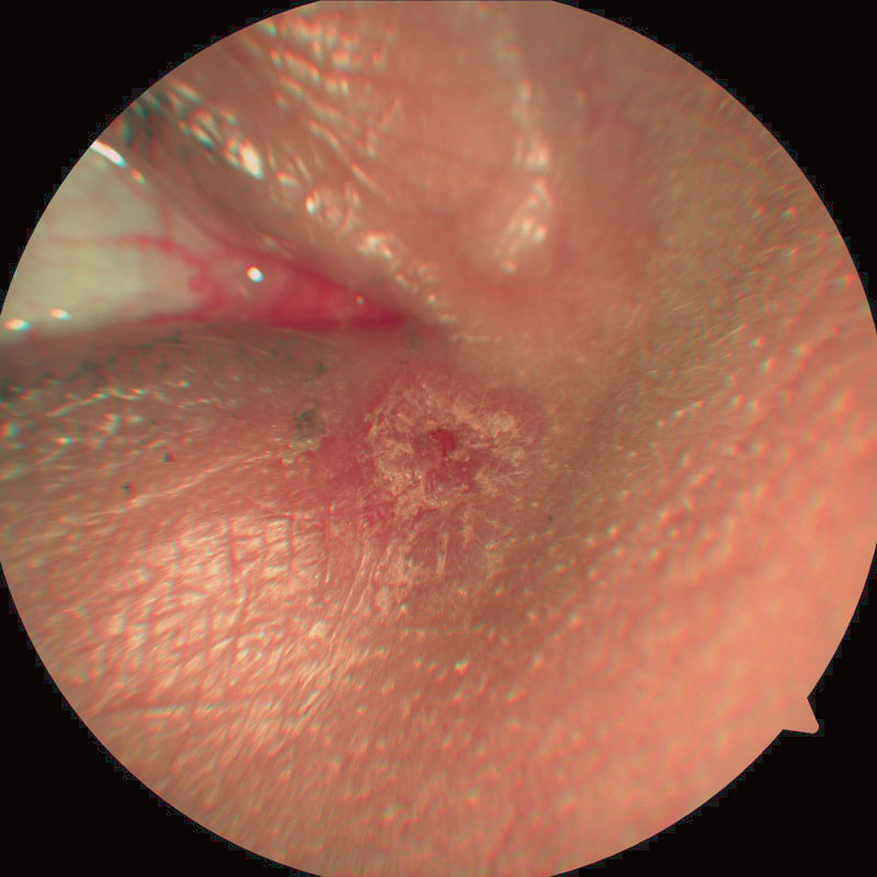 Basal cell carcinoma (BCC) medial canthus
