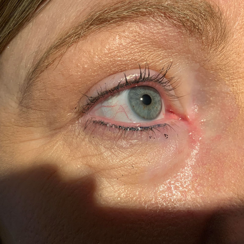 1 month after BCC excision with upper eyelid skin graft