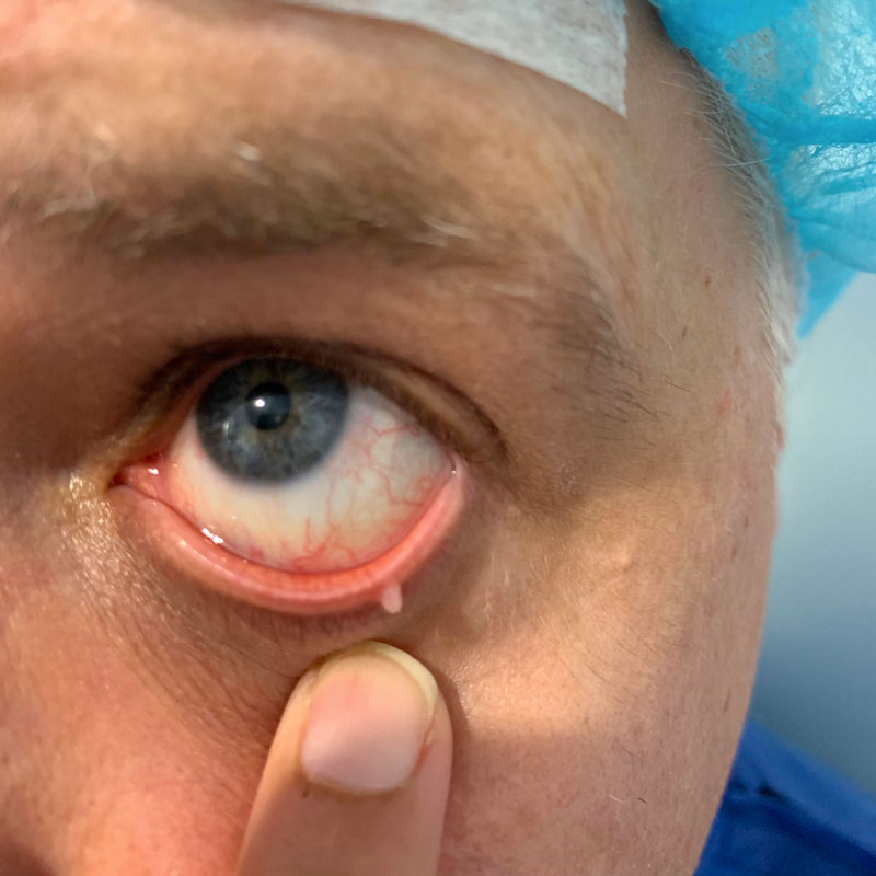 Lid lesion: left lower eyelid BEFORE