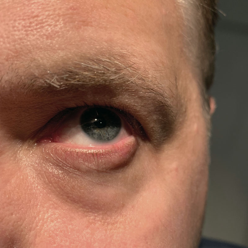Lid lesion: left lower eyelid AFTER