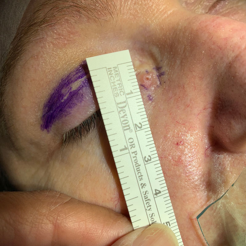 BCC measurement before surgical excision and skin graft