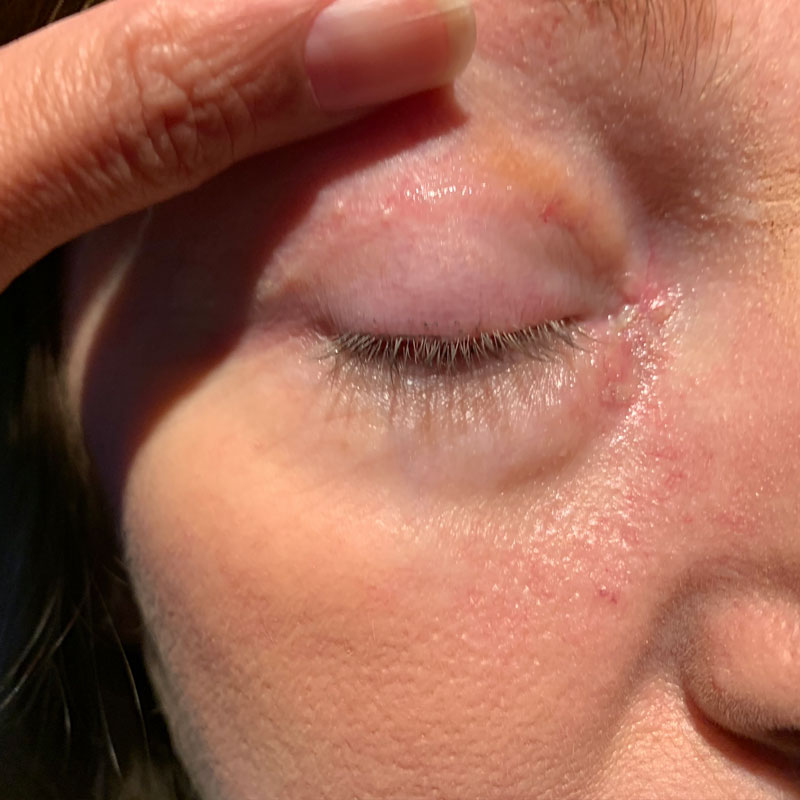 1 week after BCC excision with upper eyelid skin graft