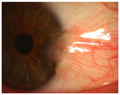Pterygium encroaching onto the cornea