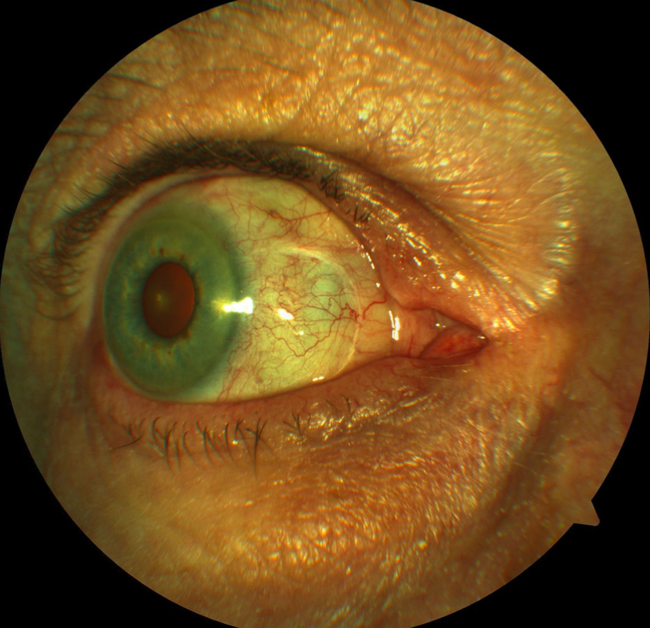 Pterygium encroaching onto the cornea